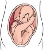 posicion-bebe-in_utero-nalgas-displasia