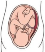 posicion-bebe-in_utero-displasia