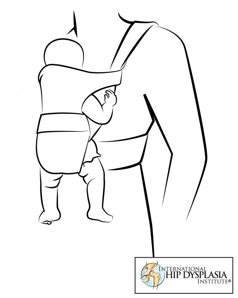 baby sling hip dysplasia